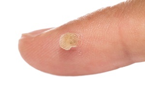 Warts - a skin disease that effectively fights Skincell For