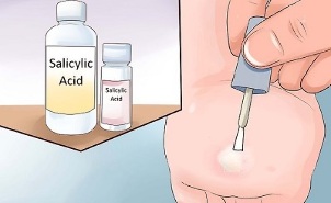 how to get rid of papillomas using folk methods
