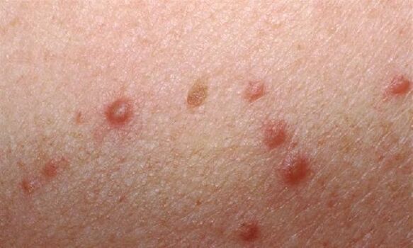 The appearance of papillomas on the skin of a woman