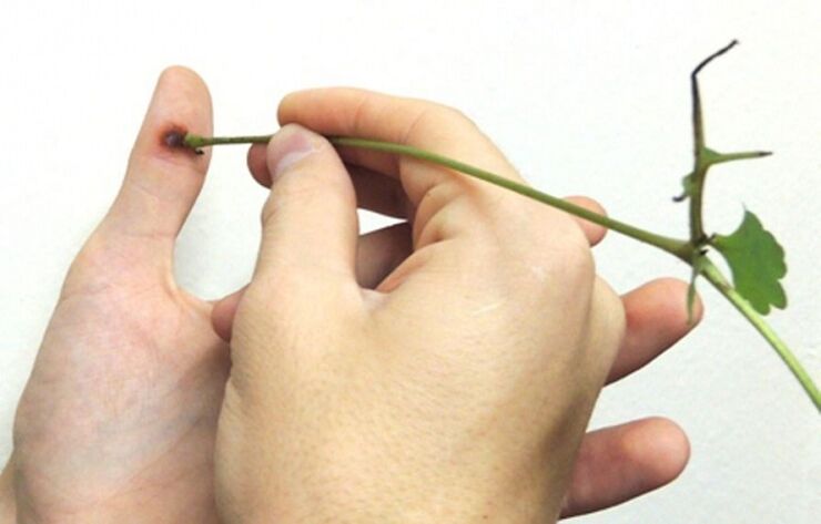 removal of a wart on a finger with celandine herb juice