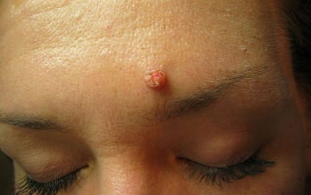 wart on forehead