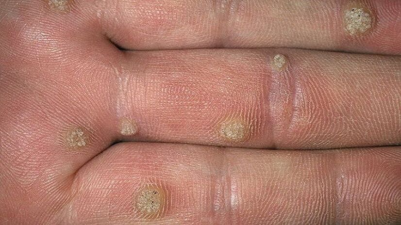 warts on fingers