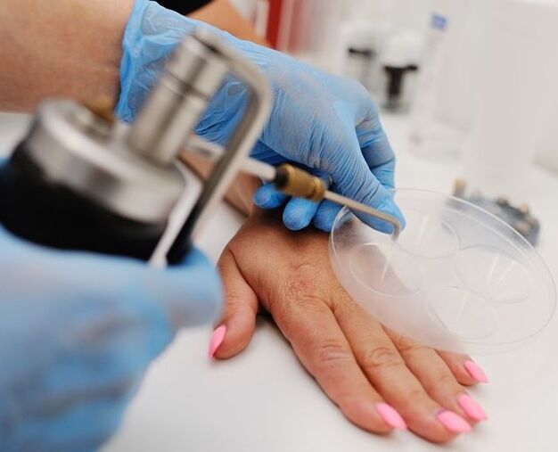 Cryodestruction - a method of removing warts from hands by freezing with liquid nitrogen