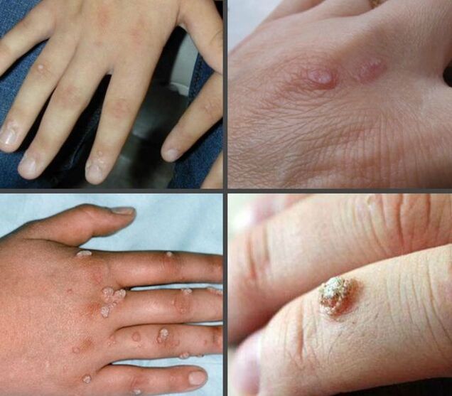 The appearance and location of warts on the hands