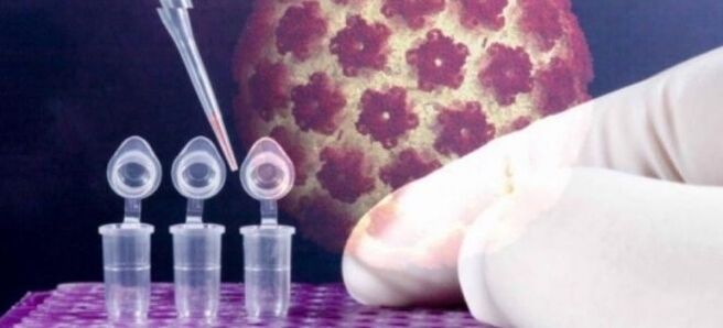 HPV diagnosis using the digene test
